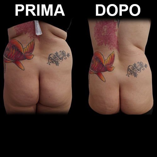 Addominoplastica con liposcultura mini invasiva