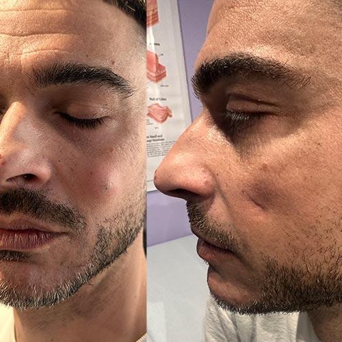 Rimozione delle cisti sebacee a milano