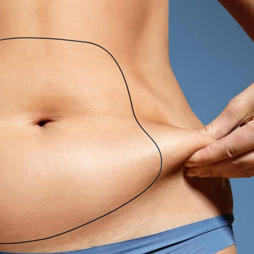 Liposcultura a Milano