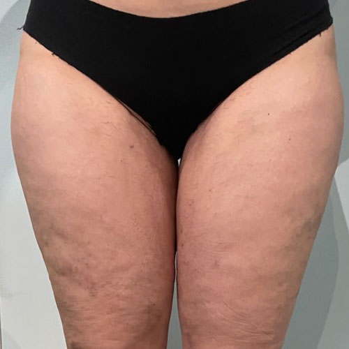 Liposcultura a Milano