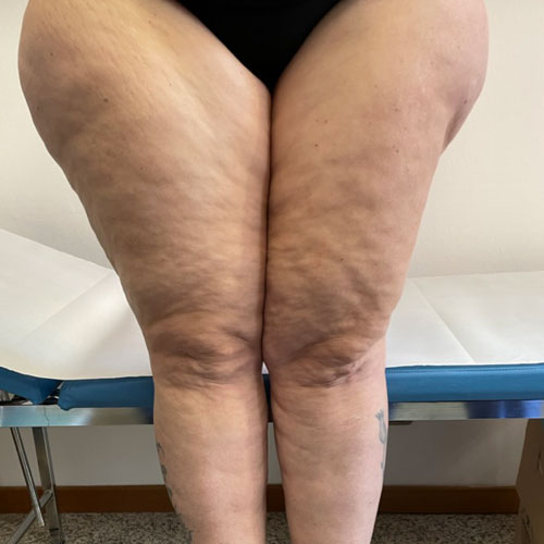 Liposcultura a Milano