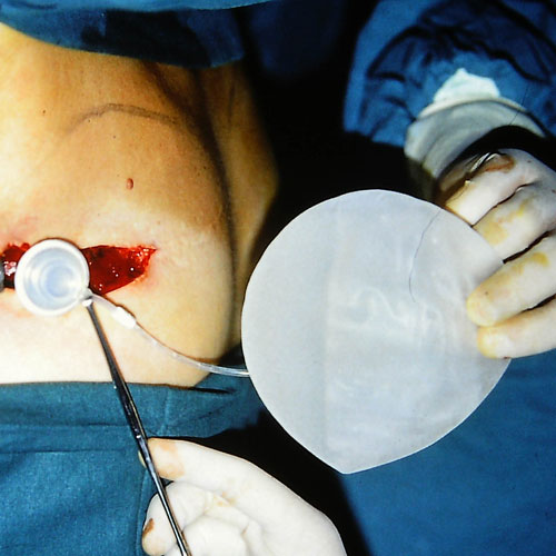 La rottura delle protesi siliconiche al seno