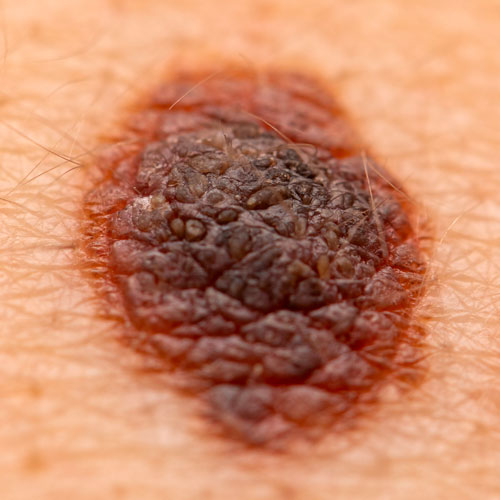 Un melanoma