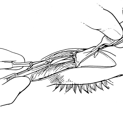 Il cedimento della palpebra superiore e la ptosi palpebrale