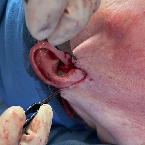 Lifting del collo, procedura chirurgica dal terzo inferiore del volto