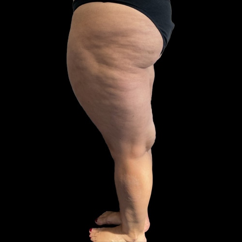 Cosa è il lipedema?