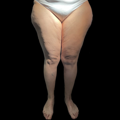 Lipedema, che cos'è? Cause, sintomi, cura.