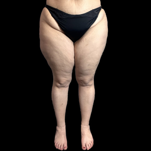 Lipedema, che cos'è? Cause, sintomi, cura.