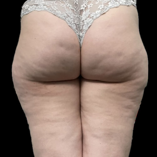 Lipedema, che cos'è? Cause, sintomi, cura.