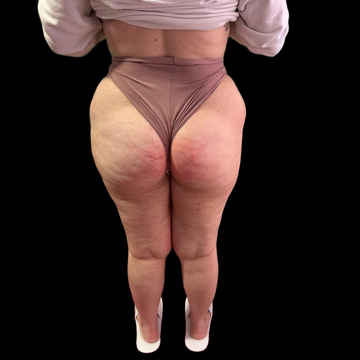 Il lipedema della donna: la malattia dei due corpi