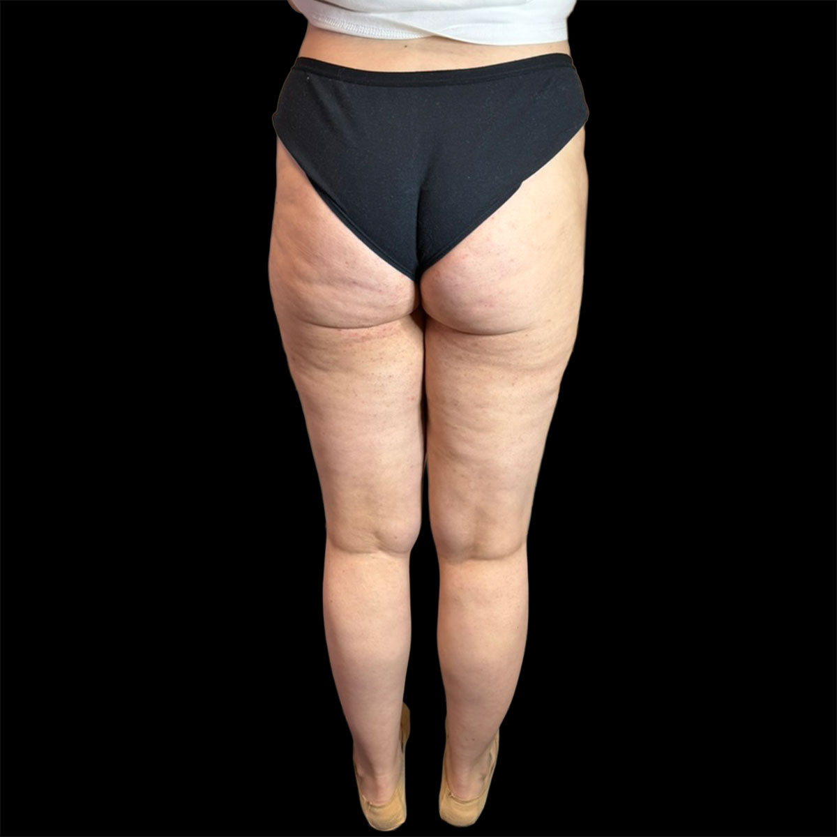 La liposuzione a Milano