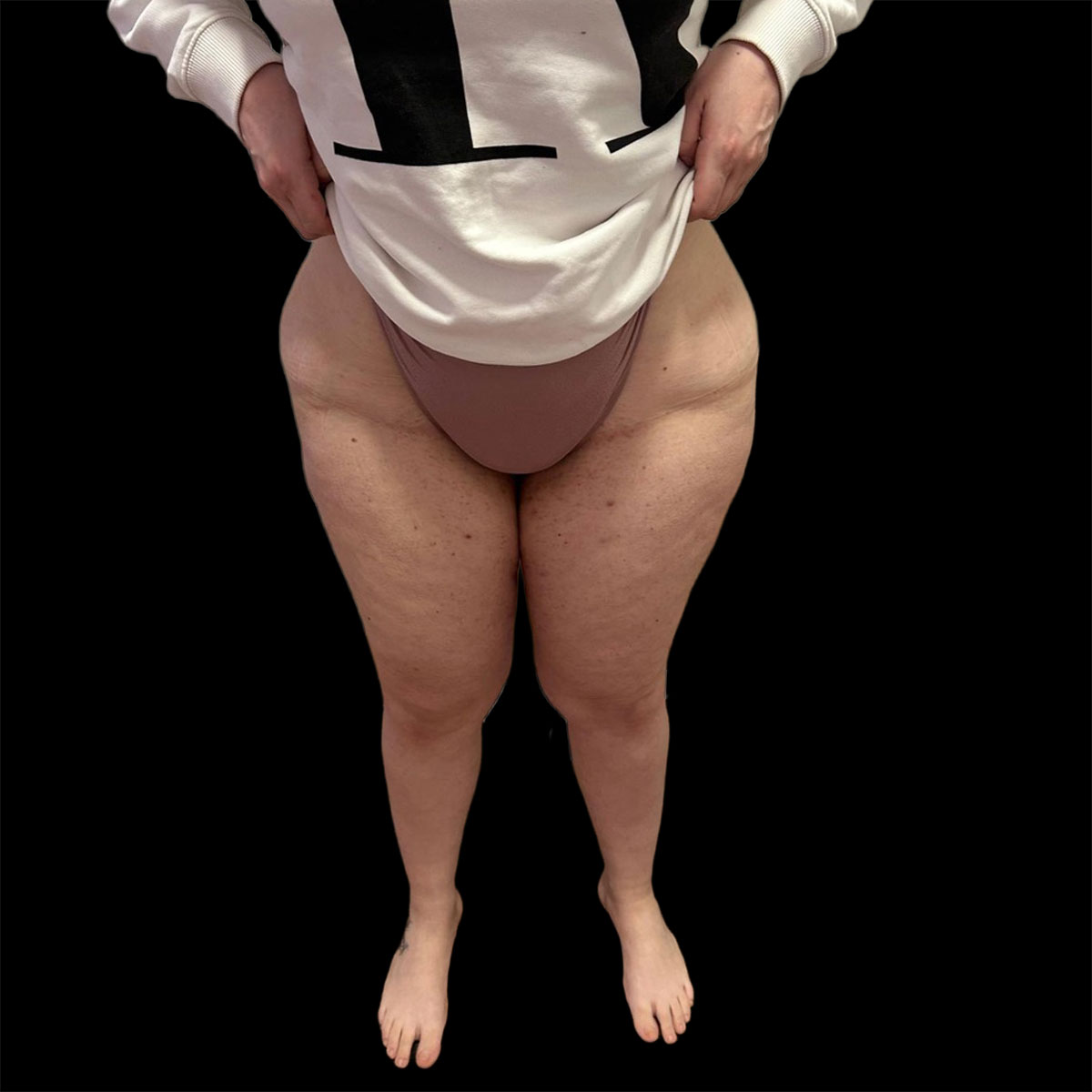 Il lipedema della donna: la malattia dei due corpi