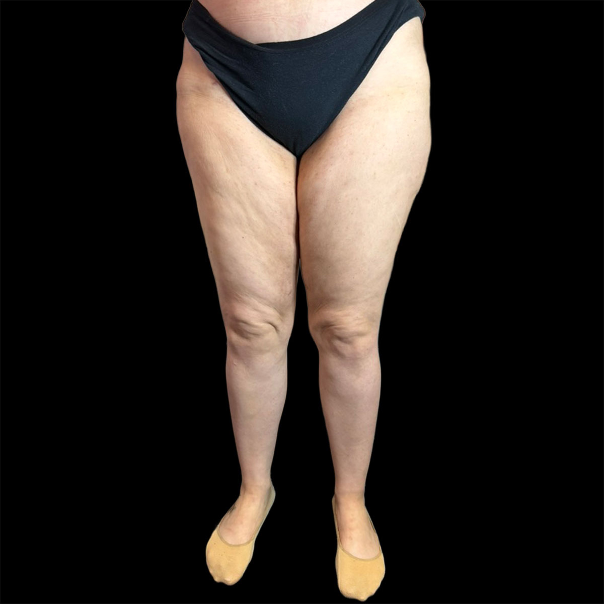 La liposuzione a Milano