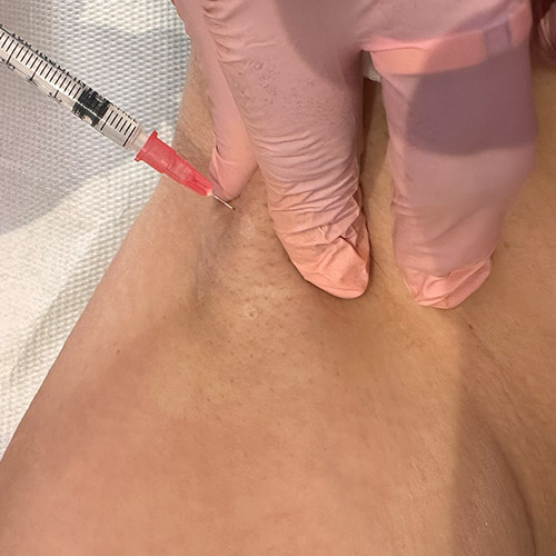 Botox per ridurre l'iperidrosi delle ascelle