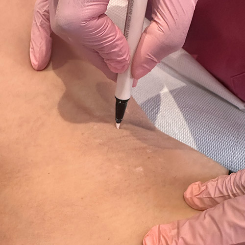 Botox per ridurre l'iperidrosi delle ascelle