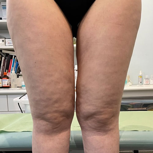 Cavitazione Medica a Milano