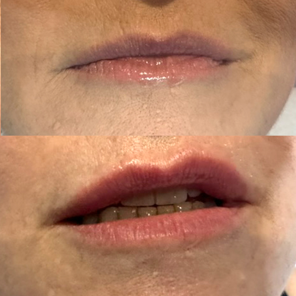 Filler all'acido ialuronico a Milano