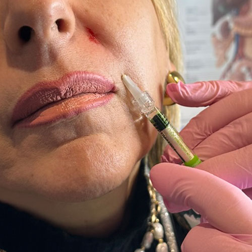 Filler all'acido ialuronico a Milano