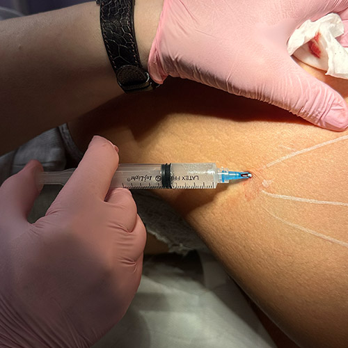 Trattamento anti-lassità a base di acido L-polilattico Sculptra
