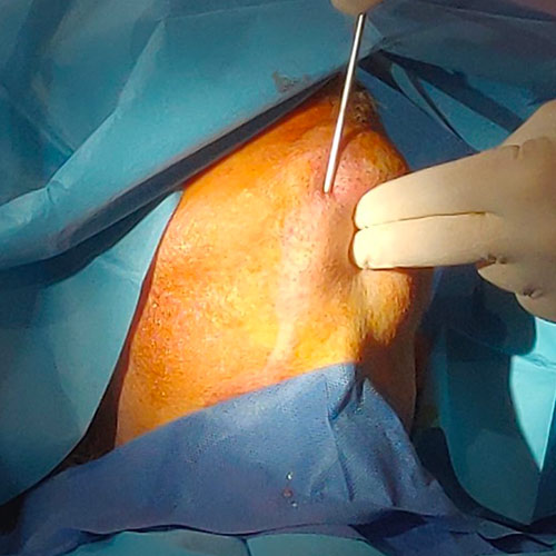 Liposcultura del mento a Milano