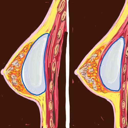 La rottura delle protesi siliconiche al seno