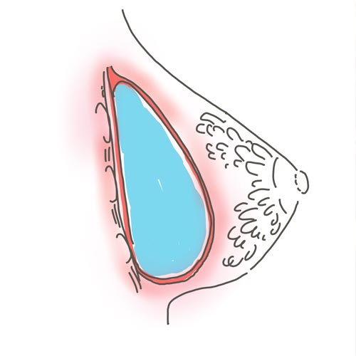 La pericapsulite, o contrazione della capsula al seno