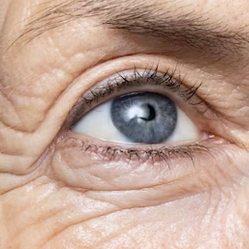La ptosi palpebrale e lo sguardo vecchio e stanco