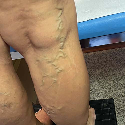 Vene varicose delle gambe