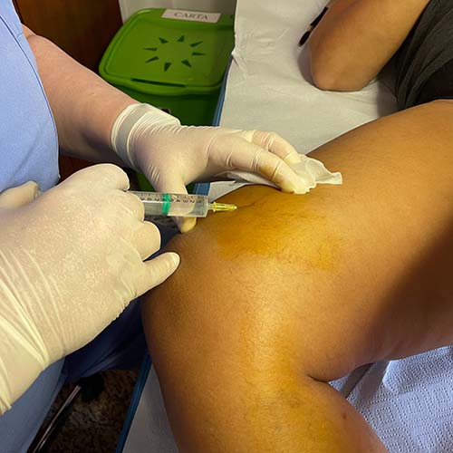 Rimozione delle varici per mezzo della terapia sclerosante