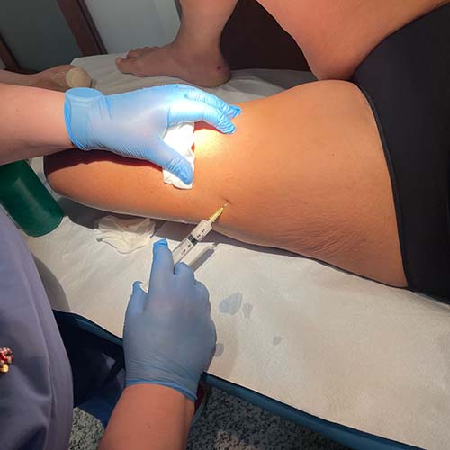 La terapia sclerosante per le varici superficiali