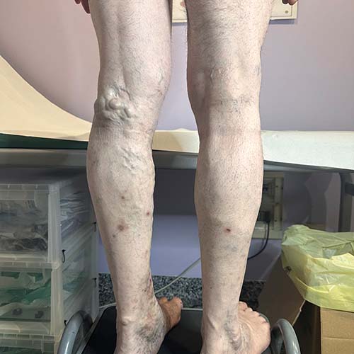 Vene varicose abnormi della gamba, peggiorate in seguito a intervento di safenectomia male eseguito