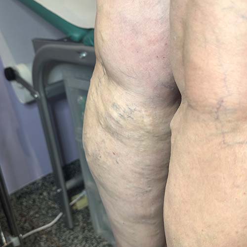 Vene varicose degli arti inferiori: ingrandimento