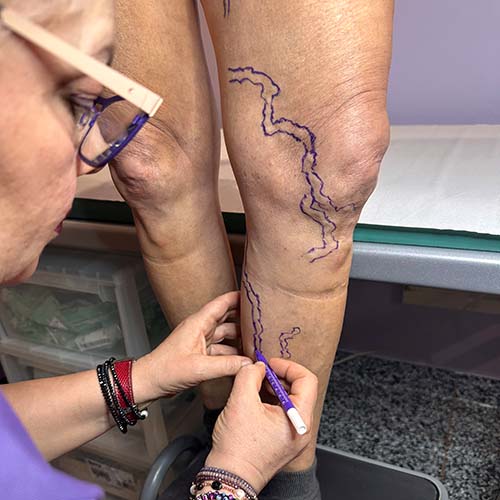 La marcatura delle varici prima della loro rimozione eseguita dal Chirurgo Vascolare