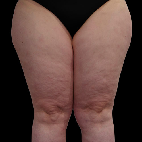 Il grasso ginoide su cosce e gambe