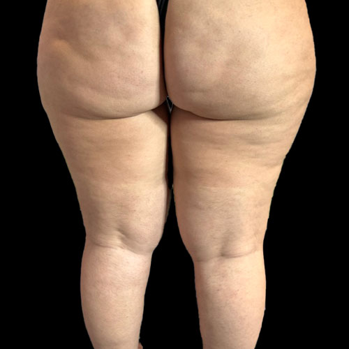 Il grasso ginoide su cosce e gambe