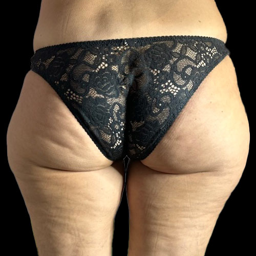 Il grasso ginoide su cosce e gambe