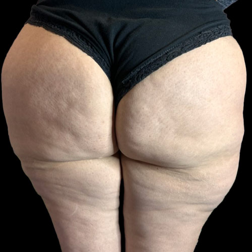 Il grasso ginoide su cosce e gambe