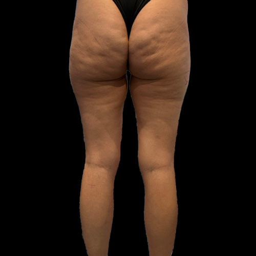Il grasso ginoide su cosce e gambe
