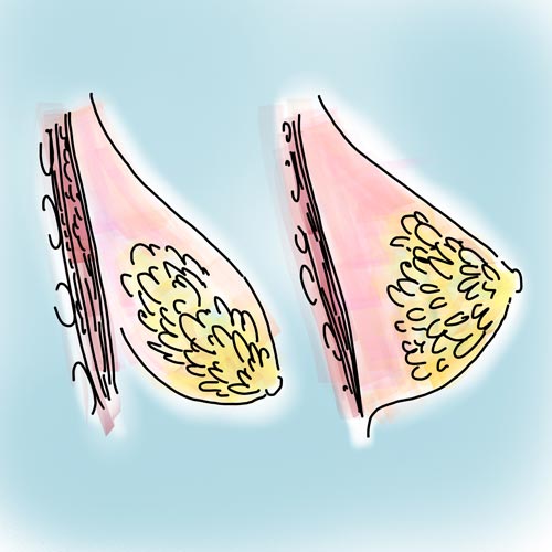 Il seno tuberoso