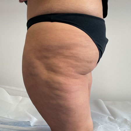 Chirurgia del lipedema a Milano